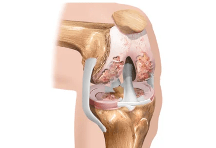 Arthrose ou arthrite des différences
