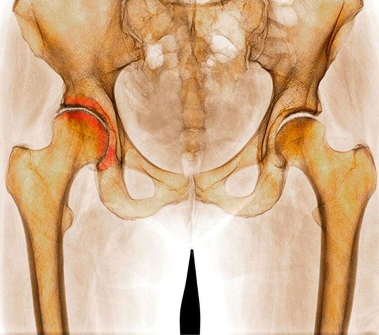 Arthrose de l'articulation de la hanche