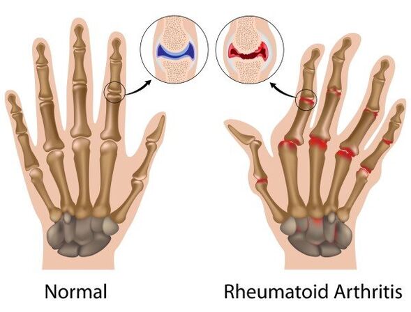 Articulations des doigts sans pathologie et avec la polyarthrite rhumatoïde