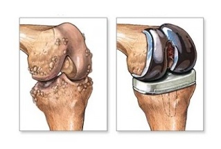 Prothèse du genou pour l'arthrose
