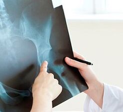 Comment traiter l'arthrose de l'articulation de la hanche