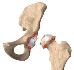 Les raisons du développement de l'arthrose de l'articulation de la hanche