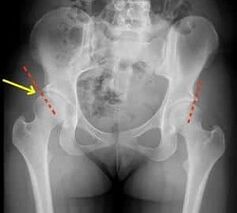 Méthodes de traitement de l'arthrose de l'articulation de la hanche