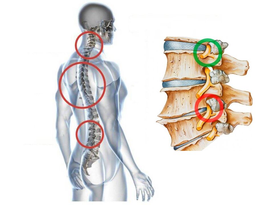 À quoi ressemble l'ostéochondose cervicale aux vertèbres