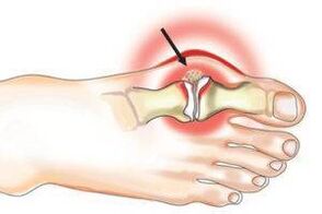Dommages articulaires causés par l'arthrite et l'arthrose