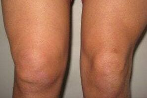 Inflammation de l'articulation du genou avec arthrite et arthrose