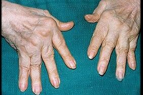 Symptômes de l'arthrite dans les doigts