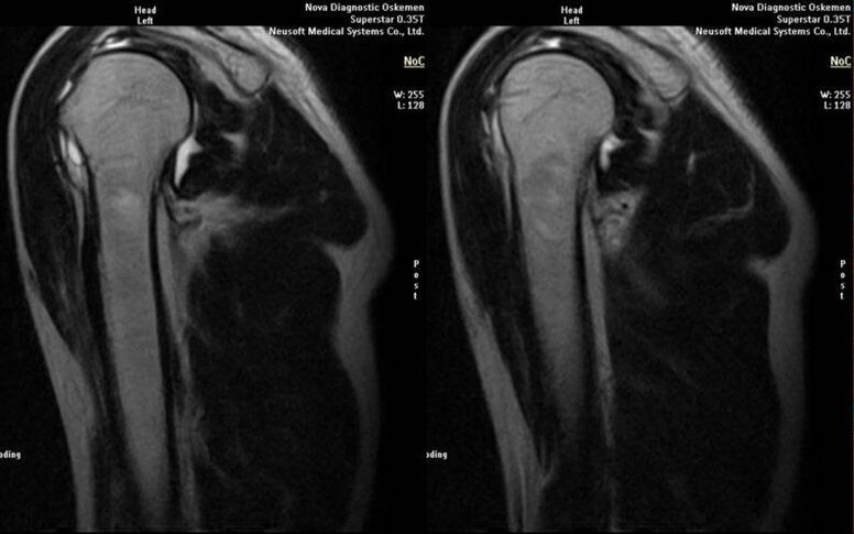 Arthrose de l'articulation de l'épaule à la radiographie