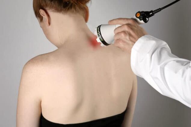 La thérapie au laser est utilisée pour lutter contre les maux de dos dans la région de l'omoplate. 