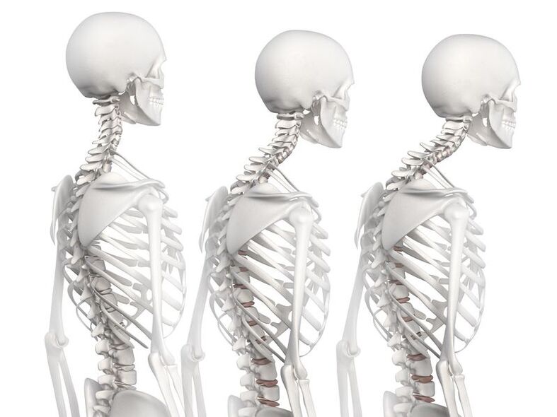 Degrés de développement de l'ostéochondrose thoracique à l'aide de l'exemple d'un modèle squelettique